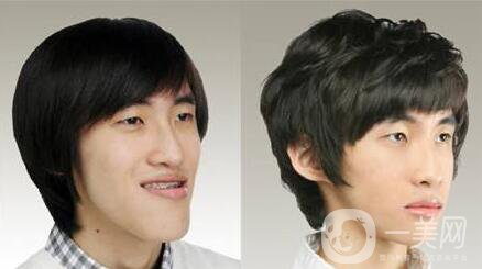 頜骨矯正,北京頜骨矯正價格,頜骨矯正注意事項