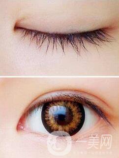 開完眼角怎么預(yù)防增生？