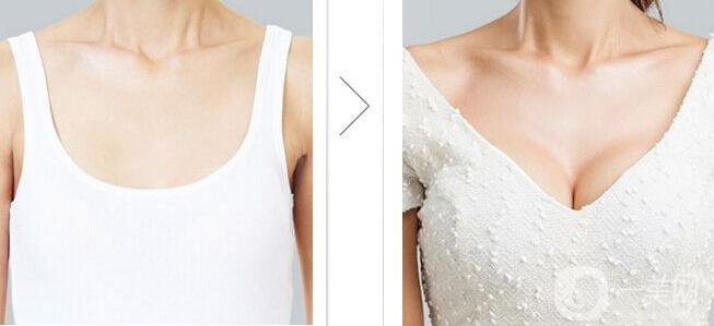 假體豐胸,假體豐胸注意事項