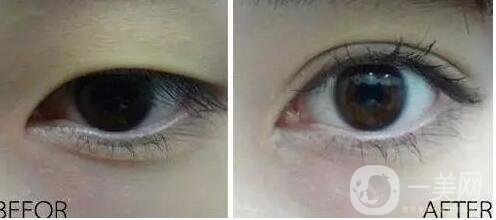 韓式開(kāi)眼角,廣州韓式開(kāi)眼角多少錢(qián)