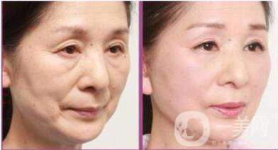 整形拉皮除皺手術(shù)多少錢 術(shù)后護(hù)理怎么做