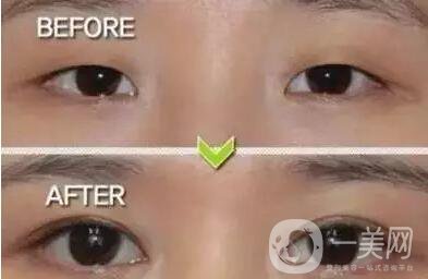 上海開眼角雙眼皮多少錢,上海開眼角多少錢,上海割雙眼皮多少錢