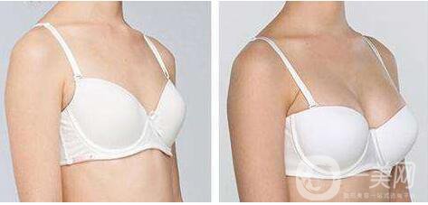 隆胸手術(shù),隆胸手術(shù)風(fēng)險(xiǎn)