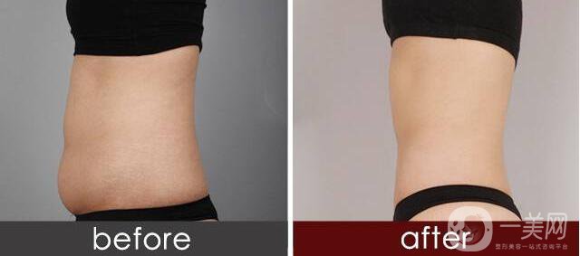 廣州溶脂減肥價(jià)格,溶脂減肥注意事項(xiàng)