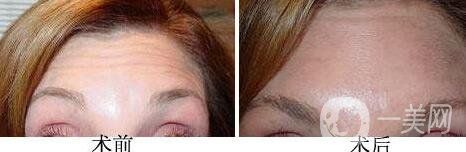 玻尿酸去抬頭紋打幾支才*果