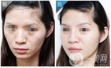 自體脂肪墊下巴術(shù)后護(hù)理注意事項(xiàng)有哪些