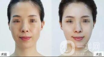 自體脂肪豐太陽穴多久消腫