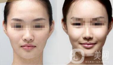 杭州自體脂肪豐蘋果肌多少錢