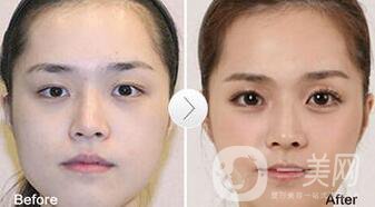 玻尿酸豐臥蠶術(shù)后護(hù)理怎么做