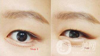 玻尿酸豐臥蠶術(shù)后護(hù)理怎么做