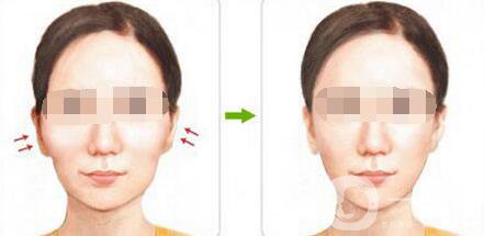 磨顴骨注意事項(xiàng)具體有哪些
