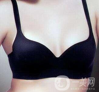 副乳切除術(shù)有后遺癥嗎？