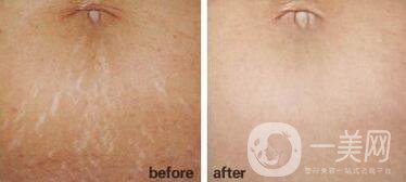 上海消除妊娠紋多少錢