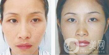 玻尿酸豐太陽穴術后護理注意事項有哪些