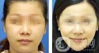 玻尿酸豐太陽穴術后護理注意事項有哪些