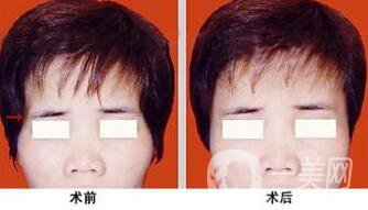 玻尿酸豐太陽穴術后護理注意事項有哪些