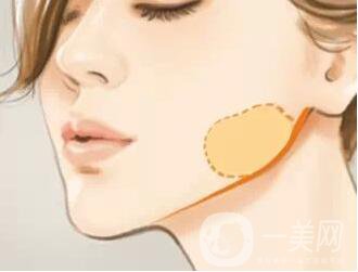 去頰脂墊瘦臉多少錢？