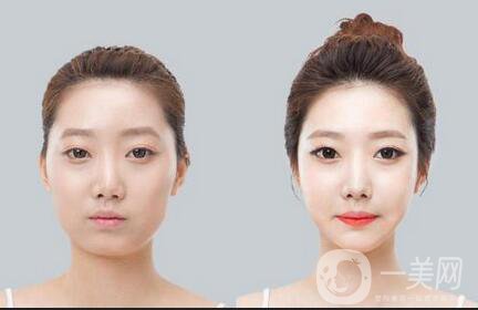 自體脂肪豐太陽穴*果能維持多久？