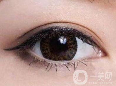 怎樣判斷雙眼皮增生了呢？