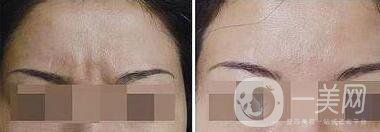 上海玻尿酸去眉間紋多少錢