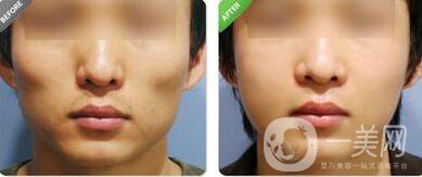 上海顴骨內(nèi)推價(jià)格是多少