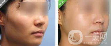 上海顴骨內(nèi)推價(jià)格是多少