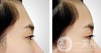 假體豐額頭維持時間是多久