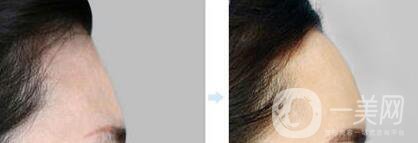 假體豐額頭維持時間是多久