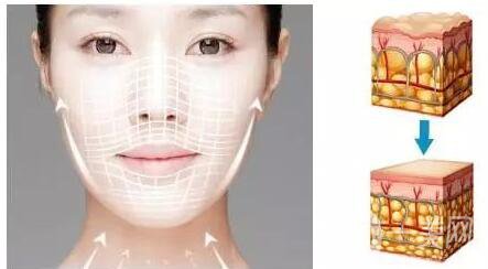 成都熱瑪吉多少錢,熱瑪吉注意事項