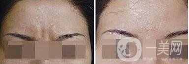 *去眉間紋維持時間是多長
