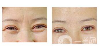 *去眉間紋維持時間是多長