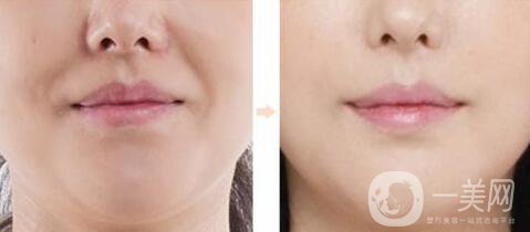 *去法令紋術后護理要怎么做