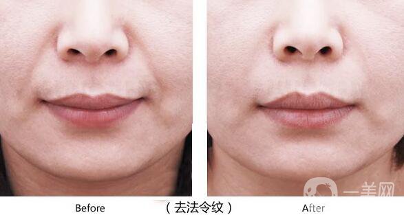 *去法令紋術后護理要怎么做