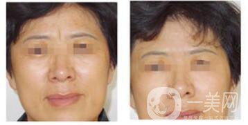 *去眉間紋后遺癥有哪些
