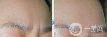*去眉間紋后遺癥有哪些