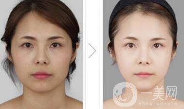 光纖溶脂好不好？?jī)r(jià)格是多少