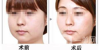 光纖溶脂好不好？?jī)r(jià)格是多少