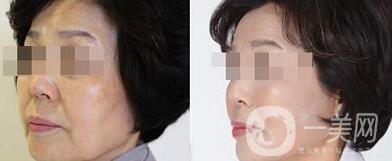 廈門做拉皮手術(shù)多少錢