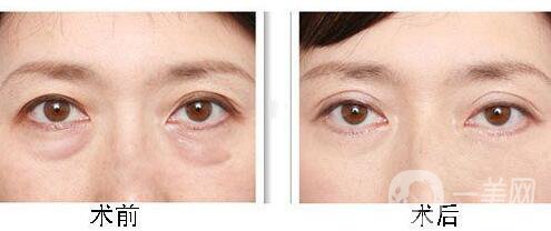 北京溶脂去眼袋價格是多少