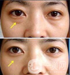 北京溶脂去眼袋價格是多少