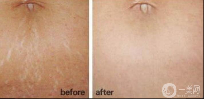 激光去妊娠紋多少錢,激光去妊娠紋術(shù)后護理