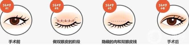 割雙眼皮埋線過程圖,埋線雙眼皮注意事項
