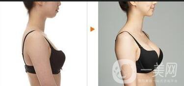 北京內(nèi)窺鏡假體豐胸價格,內(nèi)窺鏡假體豐胸*果