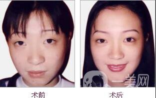 深圳膨體墊下巴價(jià)格,膨體墊下巴*果