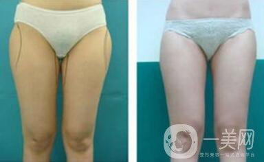 光纖溶脂瘦大腿會(huì)反彈嗎？術(shù)后注意事項(xiàng)介紹
