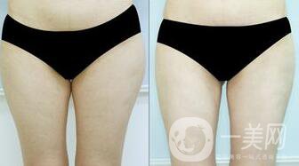 光纖溶脂瘦大腿會(huì)反彈嗎？術(shù)后注意事項(xiàng)介紹