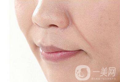 手術(shù)去法令紋*果*維持嗎