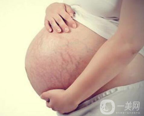 成都腹壁整形去妊娠紋多少錢,腹壁整形去妊娠紋術(shù)后護(hù)理