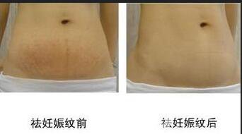 成都腹壁整形去妊娠紋多少錢,腹壁整形去妊娠紋術(shù)后護(hù)理