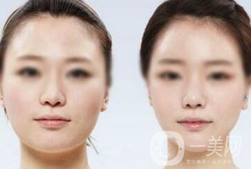 面部光纖溶脂好嗎？價(jià)格是多少